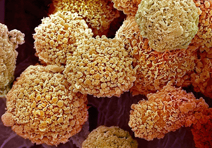 Image: Colored scanning electron micrograph (SEM) of breast cancer cells (Photo courtesy of Steve Gschmeissner / Science Photo Library).